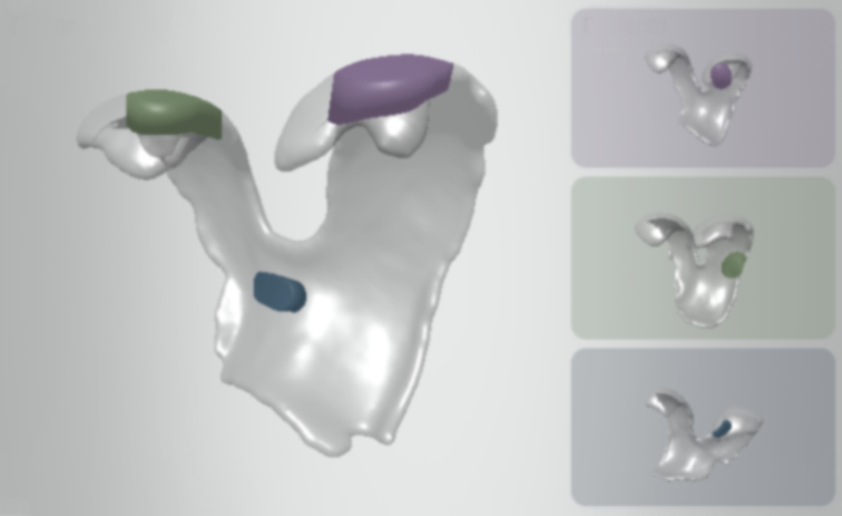 3D model: one donor cartilage matched to three patients